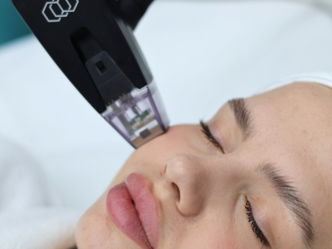 Morpheus8 RF microneedling at Evolution Aesthetics Clinic