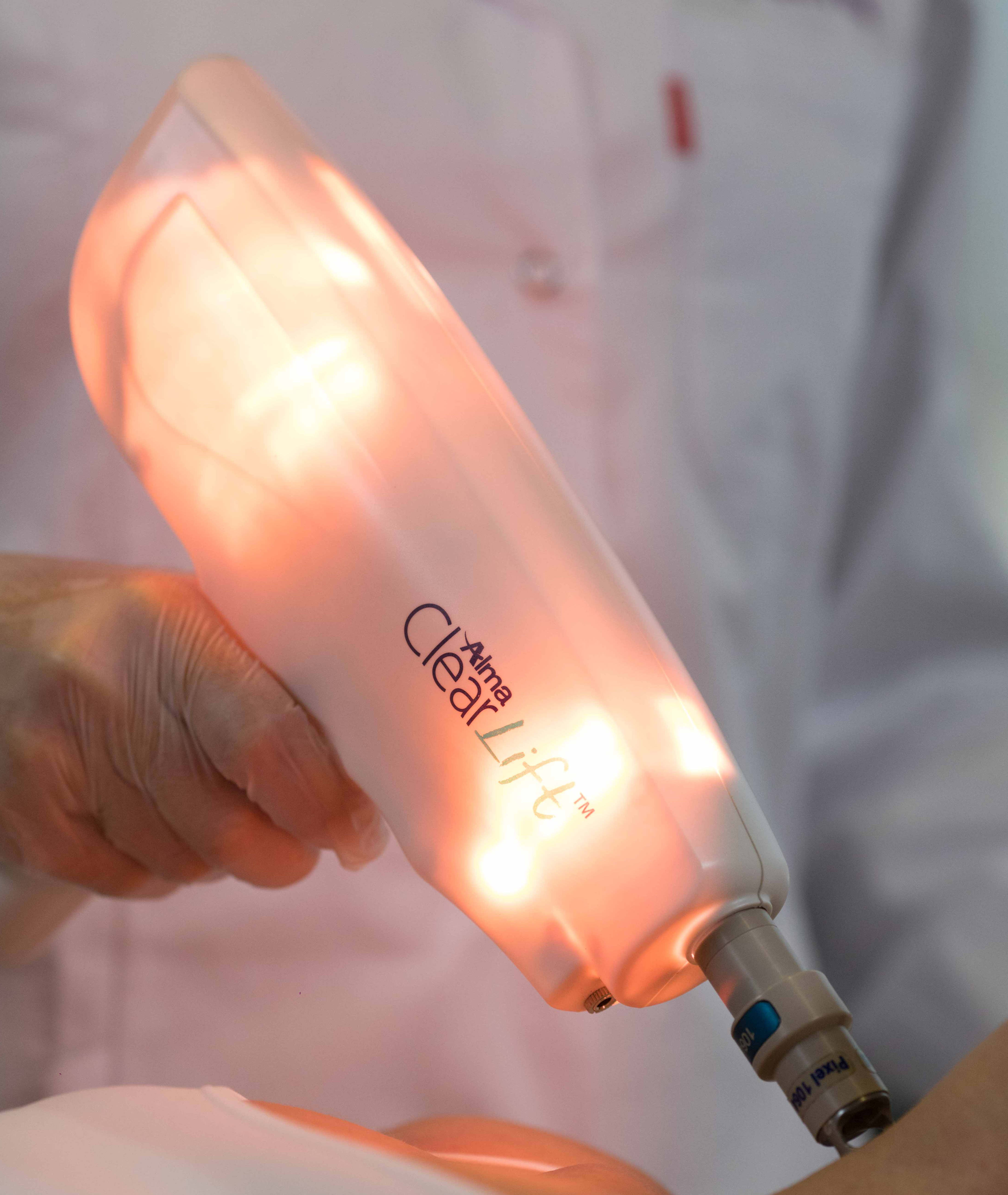 Carbon laser peel at Evolution Aesthetics Clinic