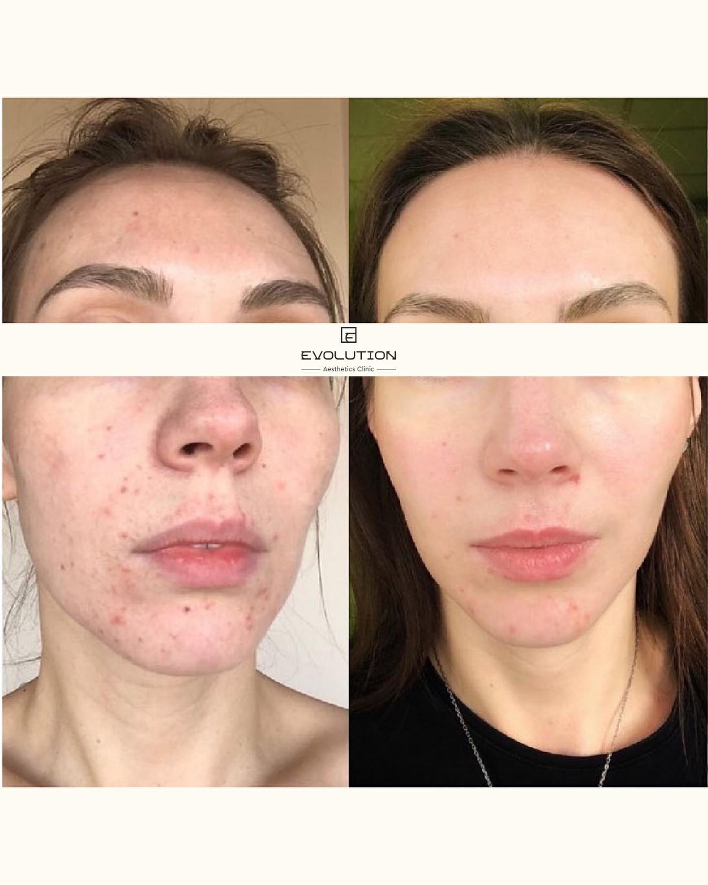 8 sessions, once a week before and after treatment result
