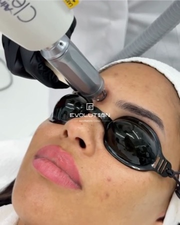 Q-switched laser tattoo removal session on the Alma Harmony XL PRO