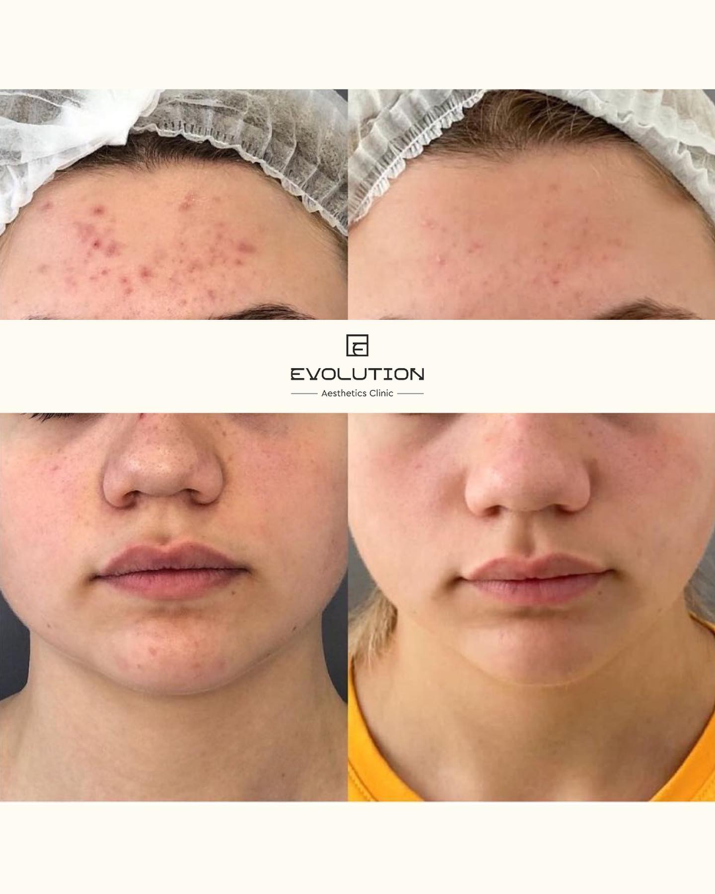 8 sessions, once a week before and after treatment result