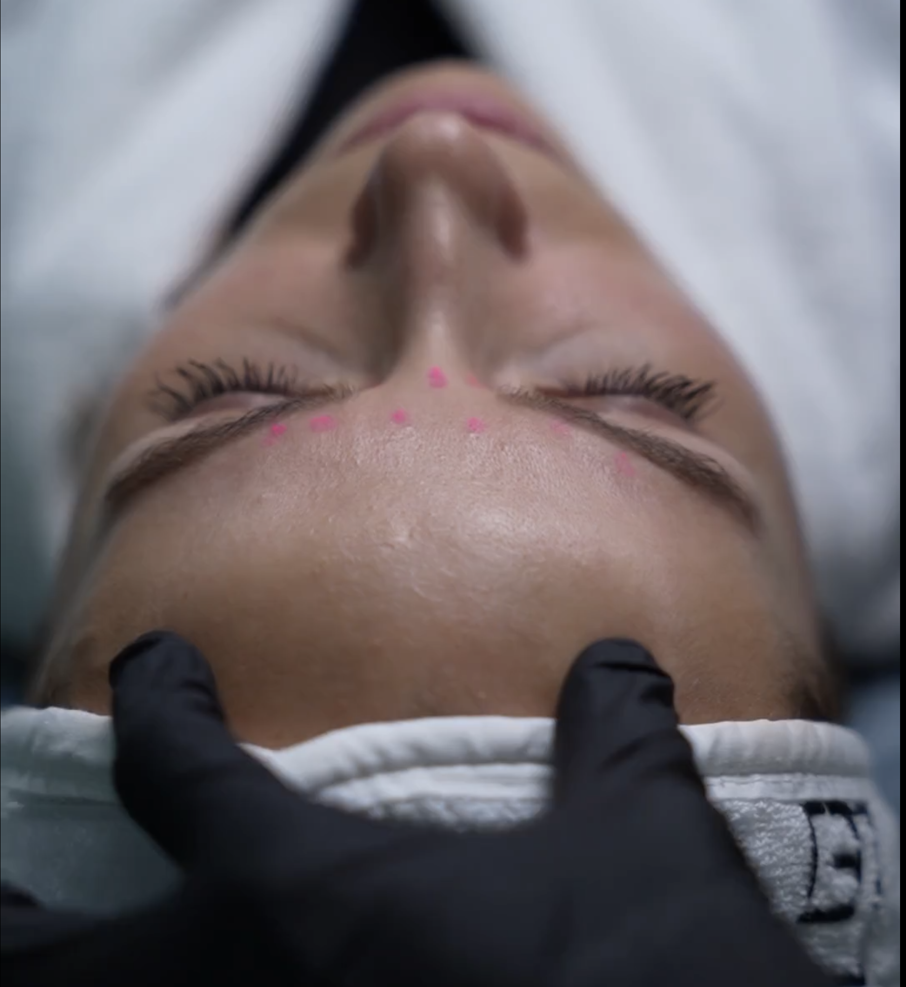 Botox Full Face welcome offer special offer