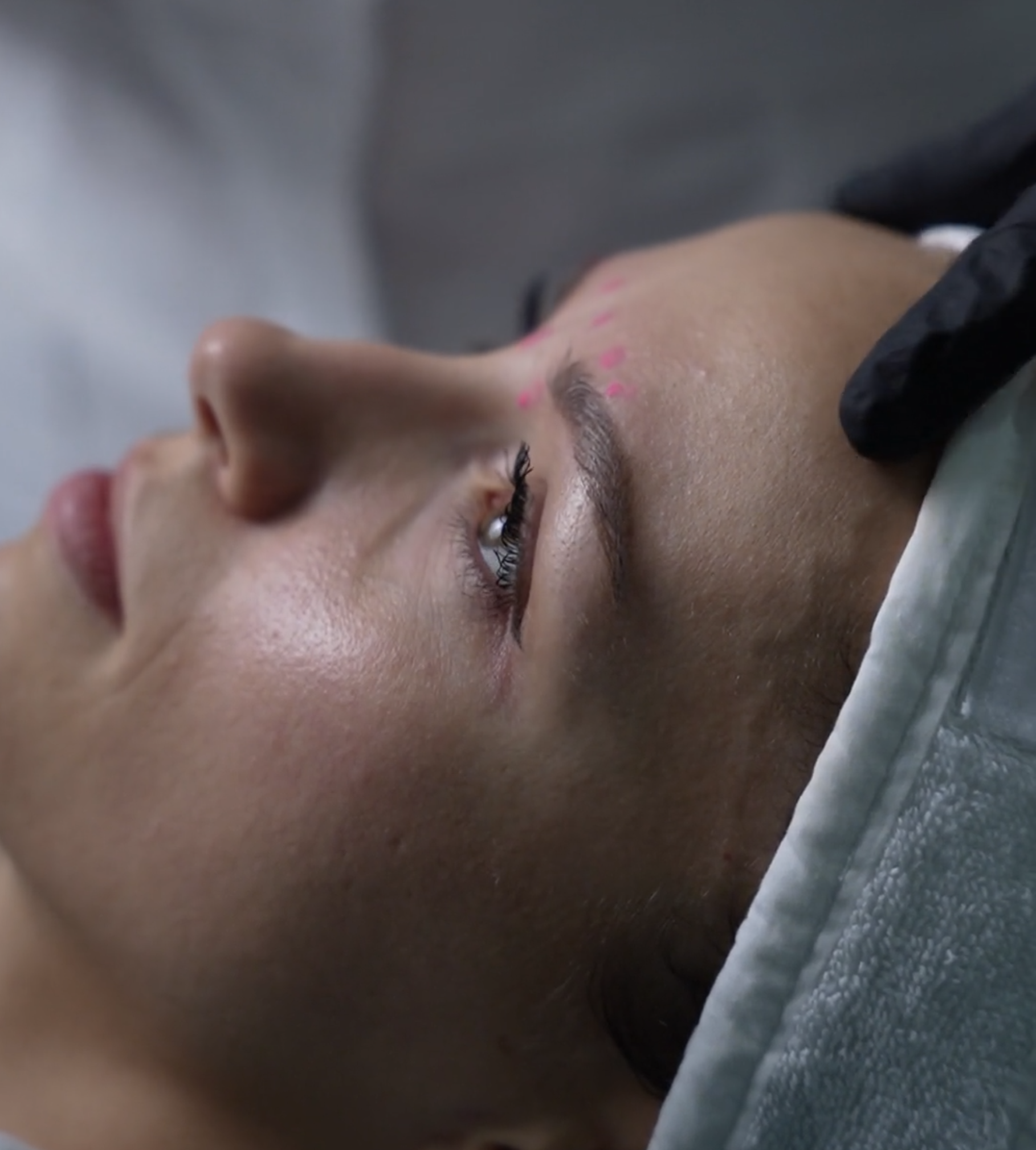 Botox crow's feet welcome offer special offer