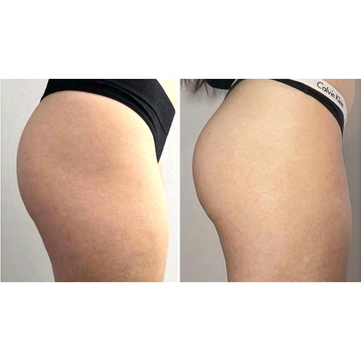 10 sessions before and after treatment result