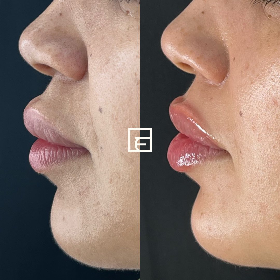 Side-by-side profile views comparing lip appearance