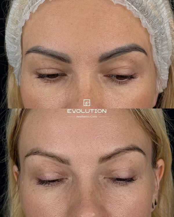 1 session before and after treatment result