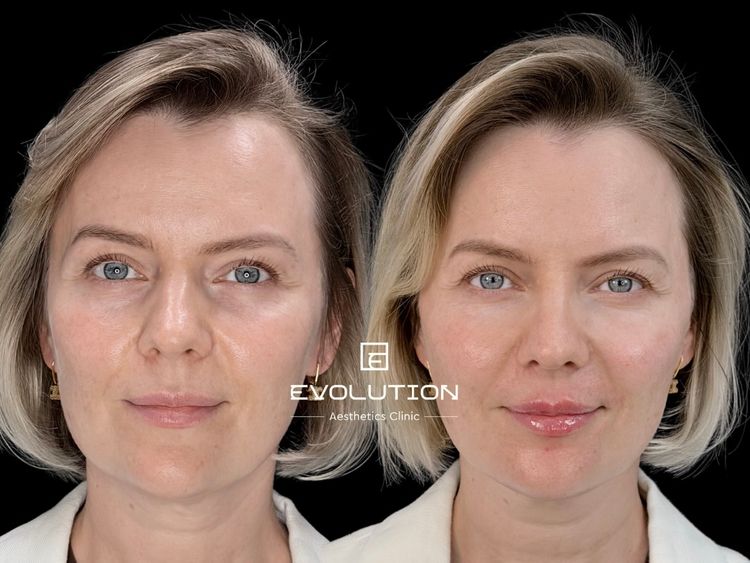 Full Face before and after treatment result
