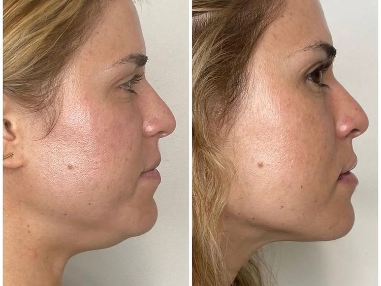 3 sessions before and after treatment result