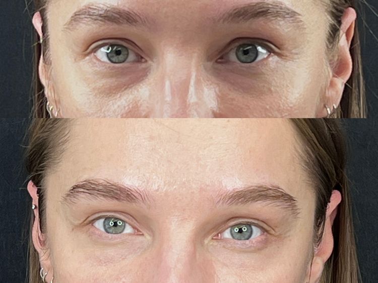 1 Session, Periorbital Area before and after treatment result