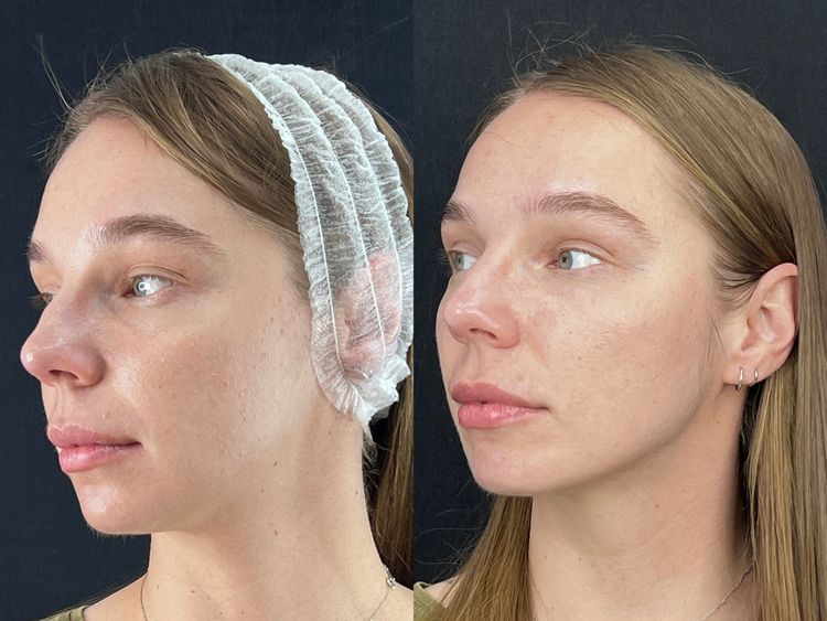 1 Session, Full Face before and after treatment result