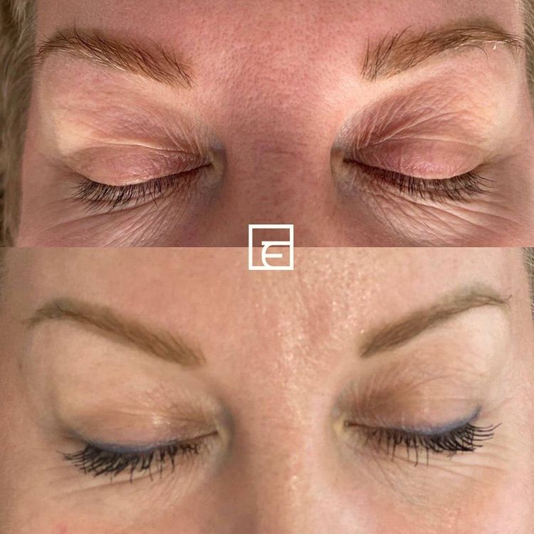 1 session before and after treatment result