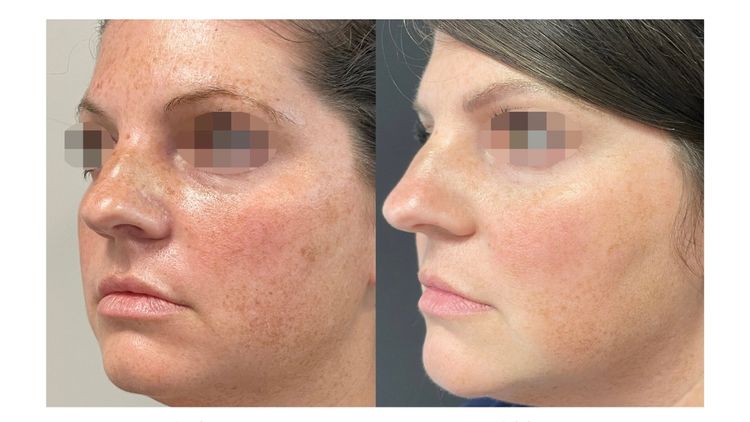 1 session before and after treatment result