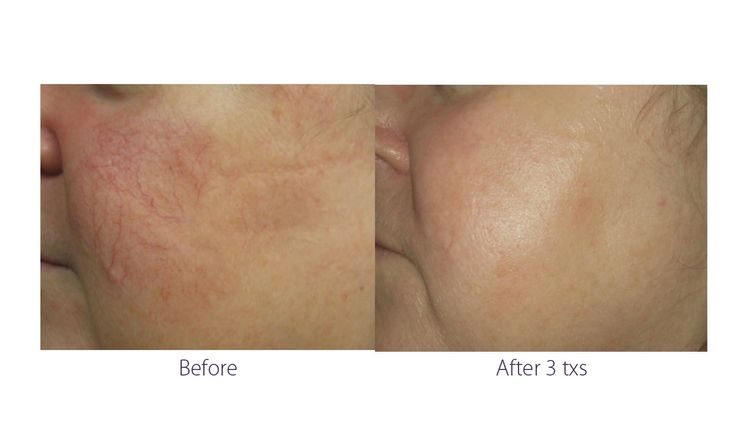 3 sessions before and after treatment result