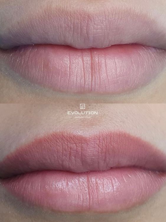 1 session before and after treatment result