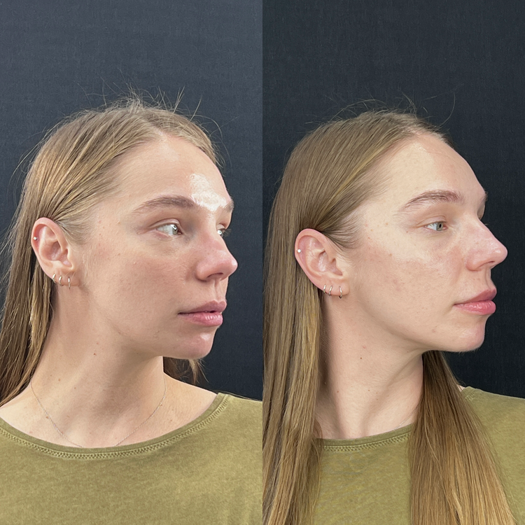1 Session, Full Face before and after treatment result