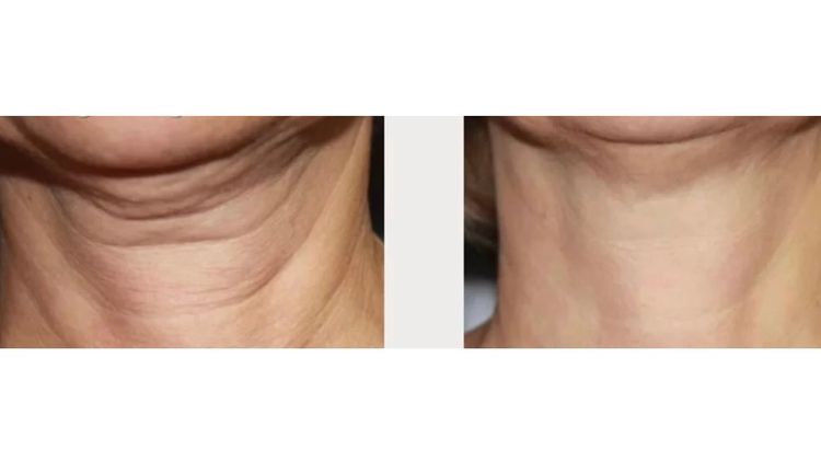 6 sessions before and after treatment result