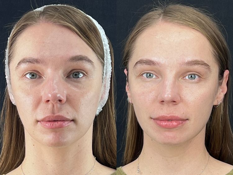 1 Session, Full Face before and after treatment result