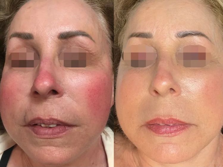 8 sessions before and after treatment result
