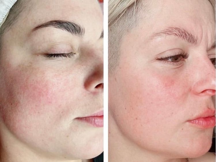 1 session before and after treatment result