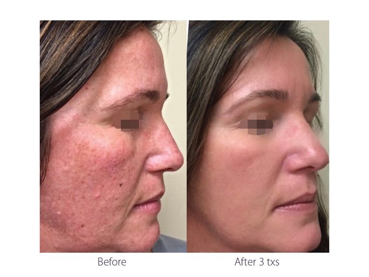 3 sessions before and after treatment result
