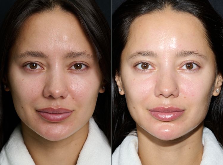 1 session before and after treatment result