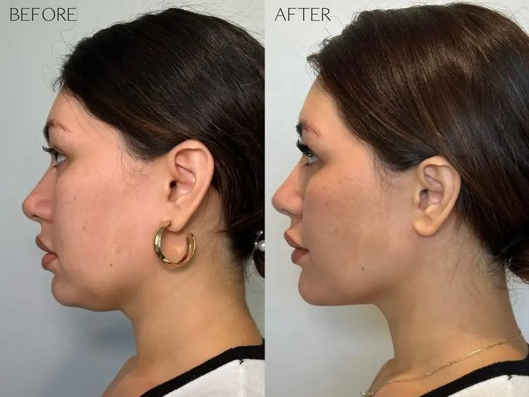 2 sessions before and after treatment result