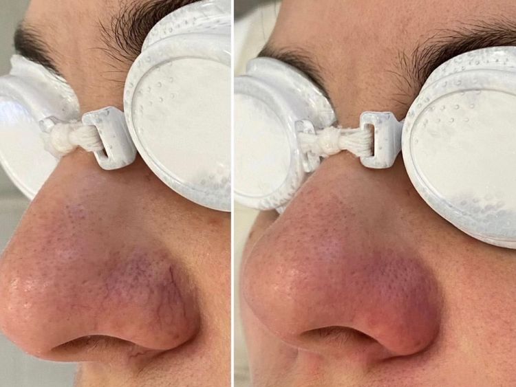 1 session before and after treatment result