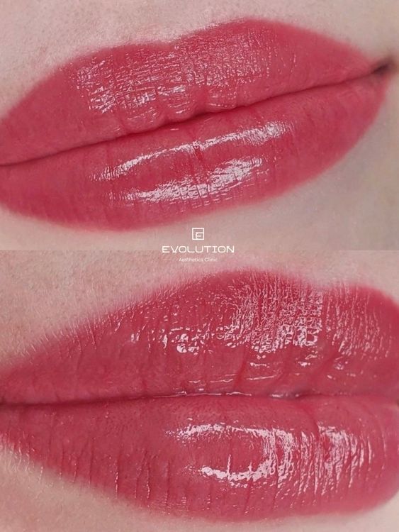 1 session before and after treatment result