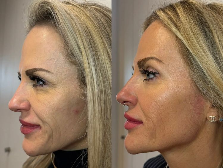 1 session before and after treatment result