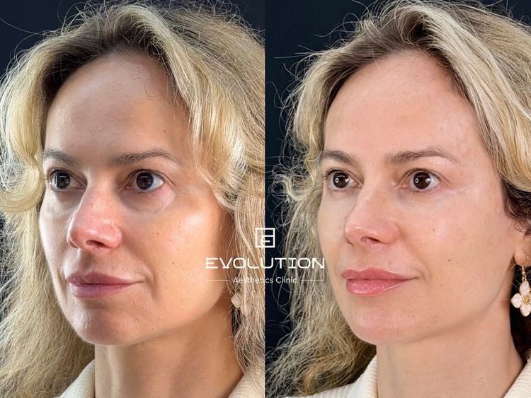 Full Face before and after treatment result