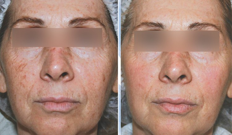 1 session before and after treatment result