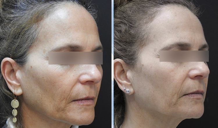 3 sessions before and after treatment result