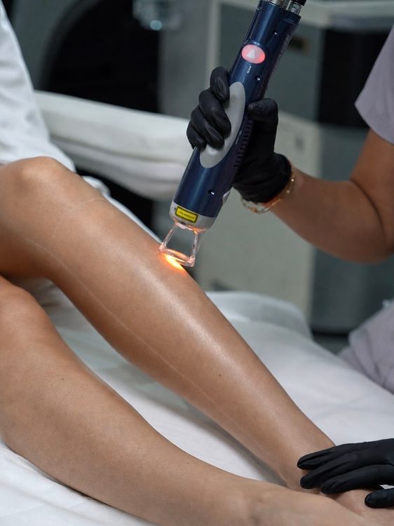Practitioner performing laser hair removal on a patient’s lower leg at Evolution Aesthetics Clinic