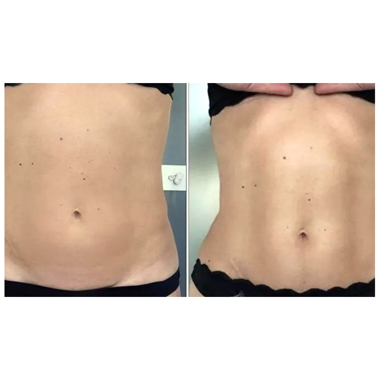8 sessions before and after treatment result