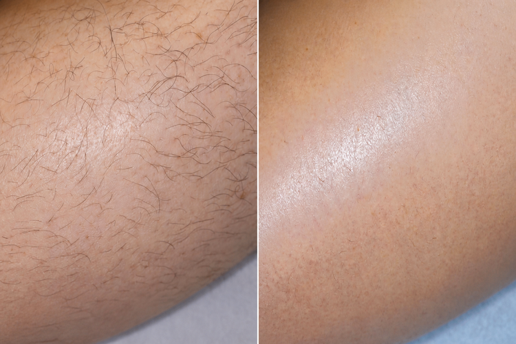 8 sessions before and after treatment result