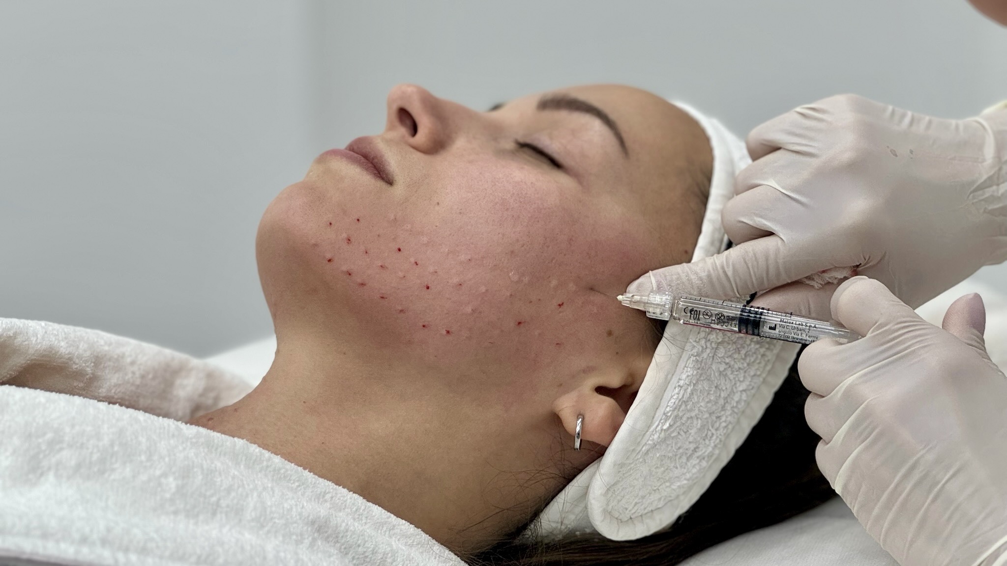 Belotero hyaluronic acid filler injected into a patient's cheek