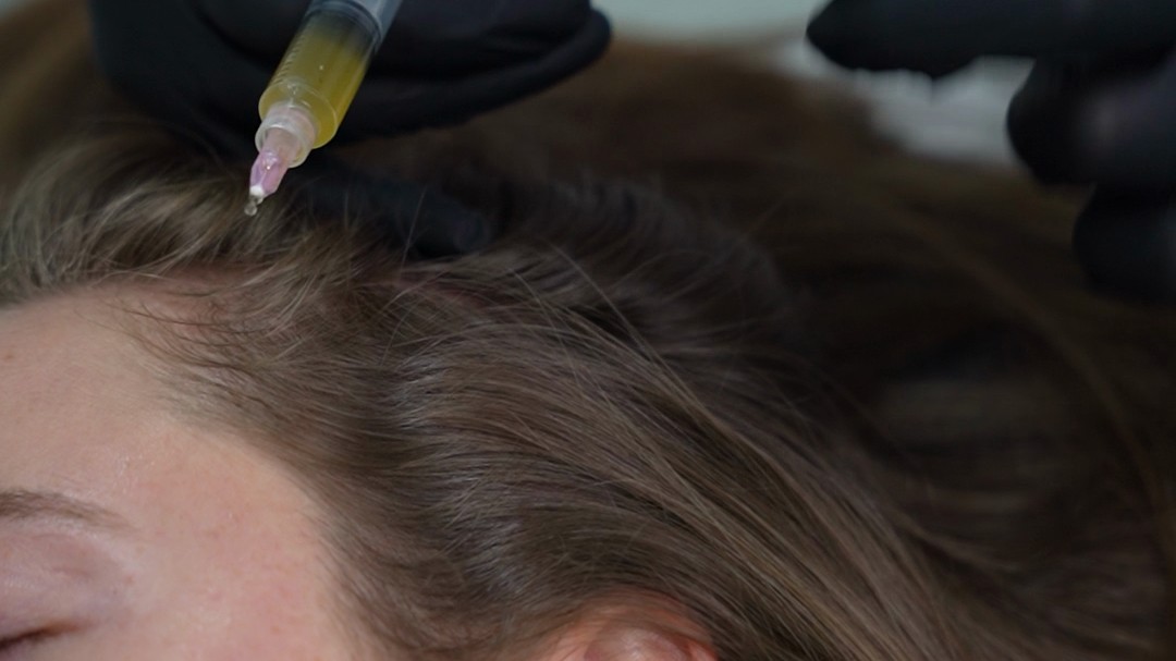 Hairline/temple is the zone patients watch for regrowth; PRP clearly identifiable