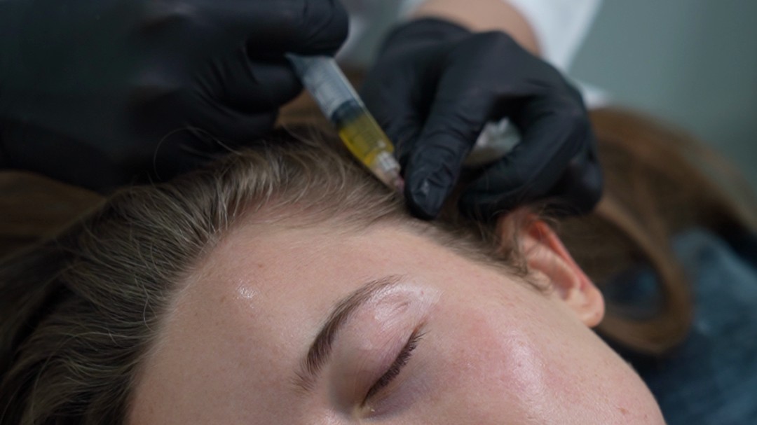 Calm patient face plus the visible PRP syringe at the scalp reads as gentle aftercare, not a scary procedure