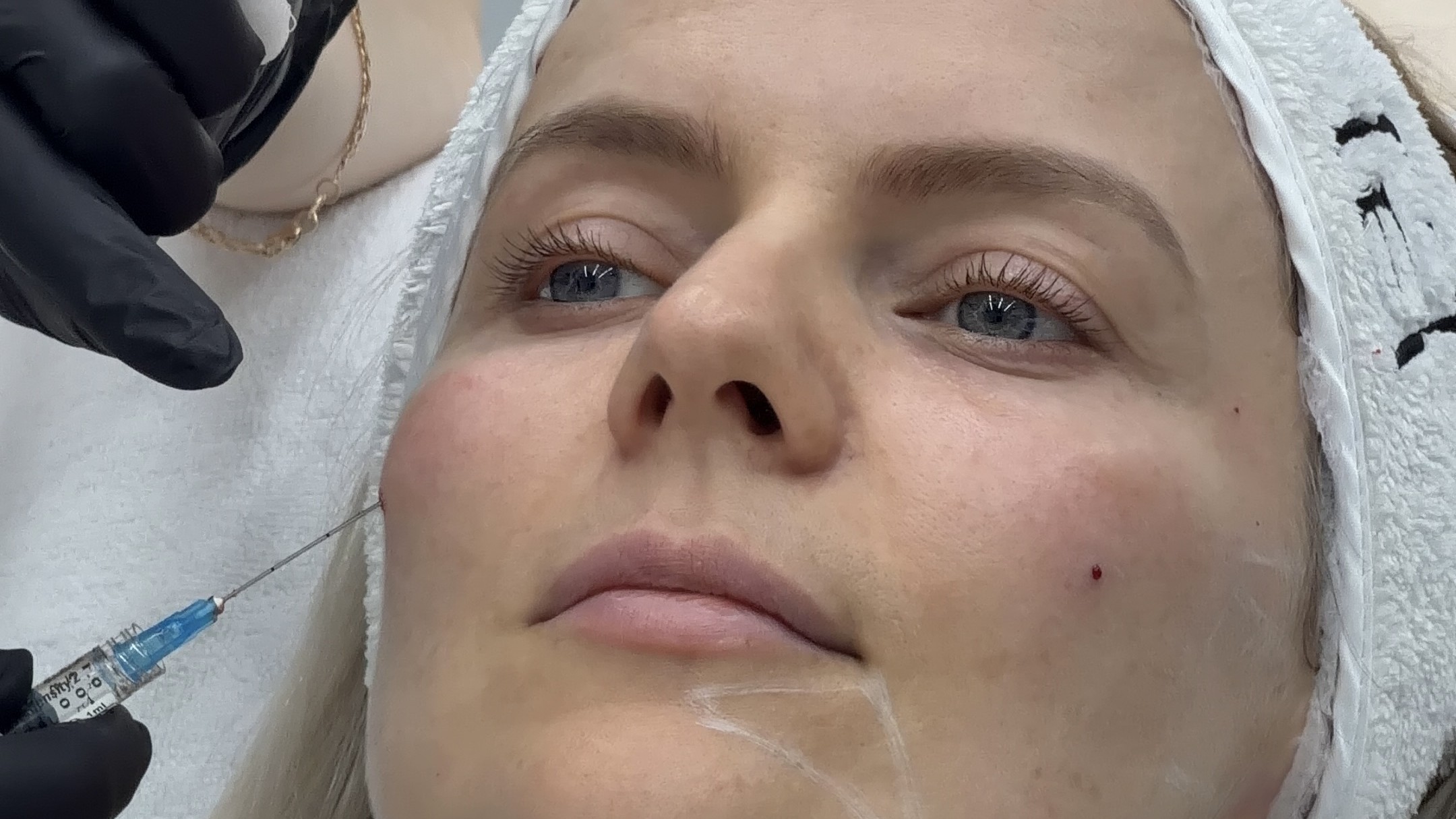 Marked injection points and needle: technique detail behind side effects