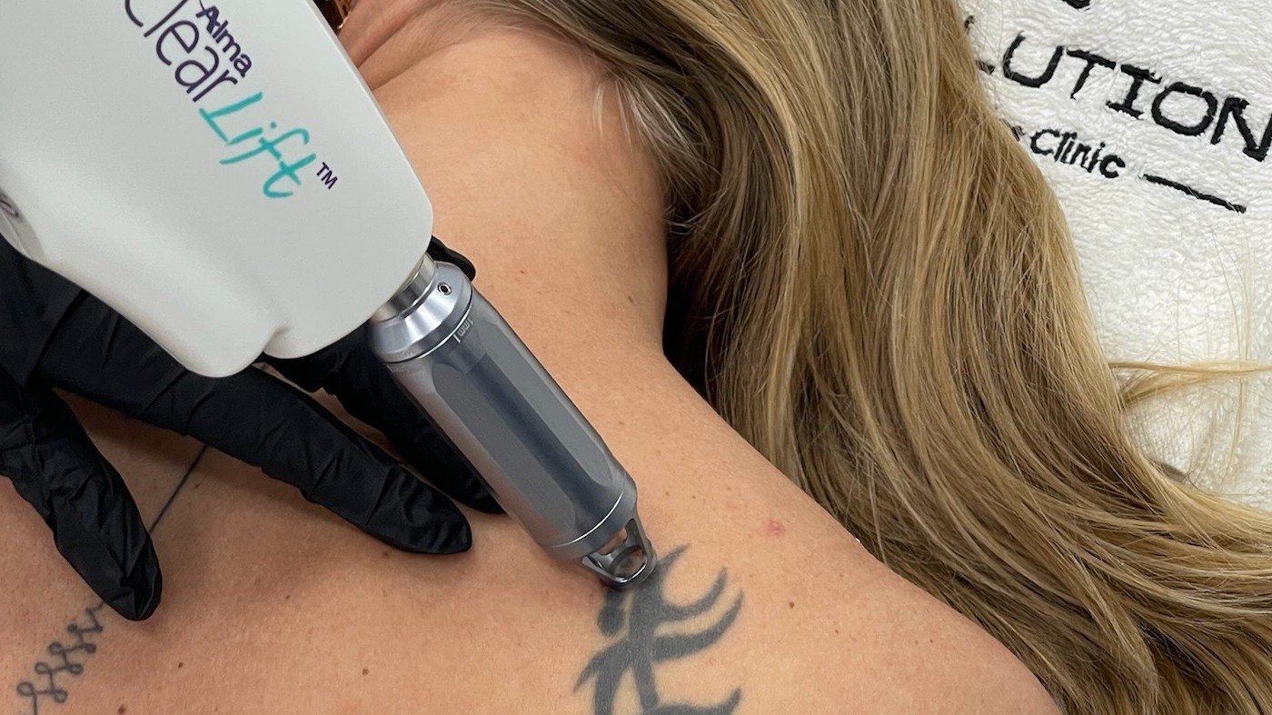 Only library shot with a real tattoo under a laser handpiece; ClearLift is a 1064 nm Q-switched platform