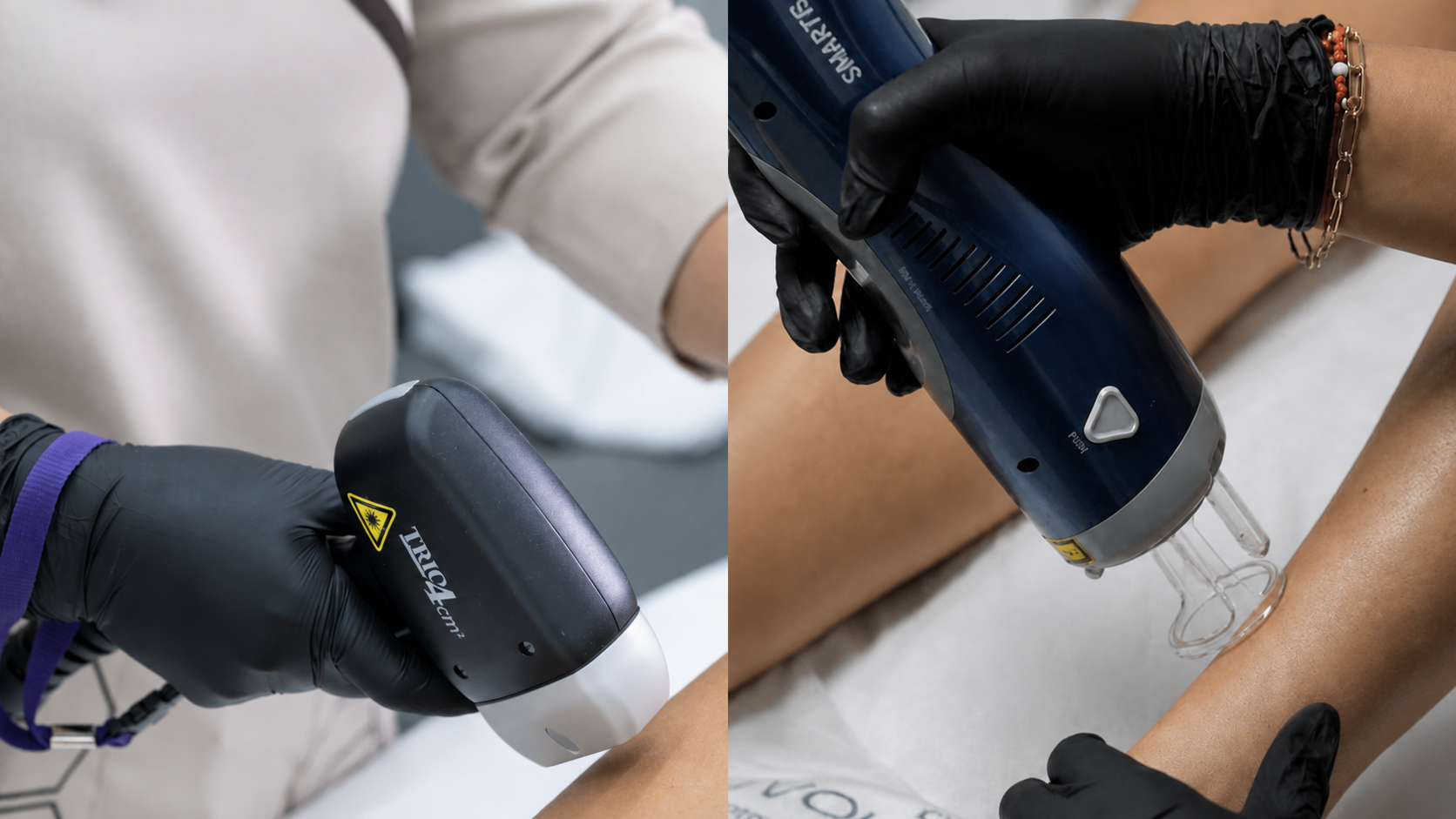 Soprano and Smartrion Alexandrite laser hair removal treatments at Evolution Aesthetics Clinic